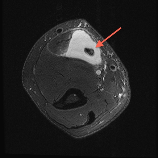 Figure 3 for case Rupture of bi-fid distal biceps tendon